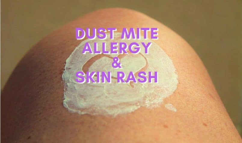 dust mite allergy and skin rash